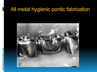 All metal hygienic pontic fabrication
 