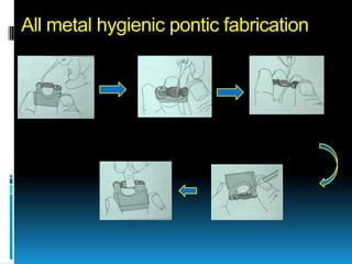 All metal hygienic pontic fabrication
 