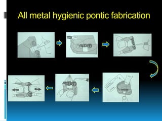 All metal hygienic pontic fabrication
 
