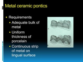 Metal ceramic pontics

 Requirements
   Adequate bulk of
    metal
   Uniform
    thickness of
    porcelain
   Continuous strip
    of metal on
    lingual surface
 