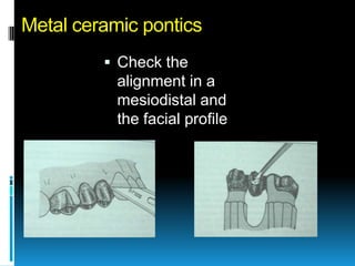 Metal ceramic pontics
          Check the
           alignment in a
           mesiodistal and
           the facial profile
 