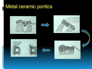 Metal ceramic pontics
 