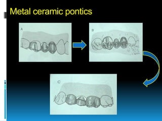 Metal ceramic pontics
 