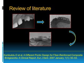Review of literature




Kumbulolu.O et al, A Different Pontic Design for Fiber-Reinforced Composite
 Bridgeworks: A Clinical Report, Eur J Dent. 2007 January; 1(1): 50–53.
 