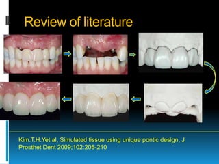 Review of literature




Kim.T.H.Yet al, Simulated tissue using unique pontic design, J
Prosthet Dent 2009;102:205-210
 