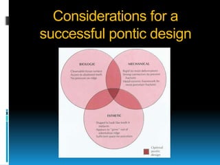 Considerations for a
successful pontic design
 
