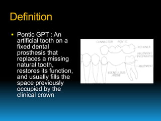 Definition
 Pontic GPT : An
  artificial tooth on a
  fixed dental
  prosthesis that
  replaces a missing
  natural tooth...