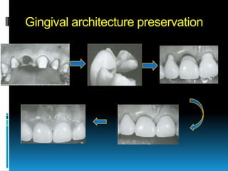 Gingival architecture preservation
 