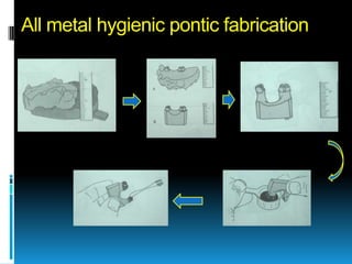 All metal hygienic pontic fabrication
 
