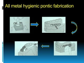 All metal hygienic pontic fabrication
 