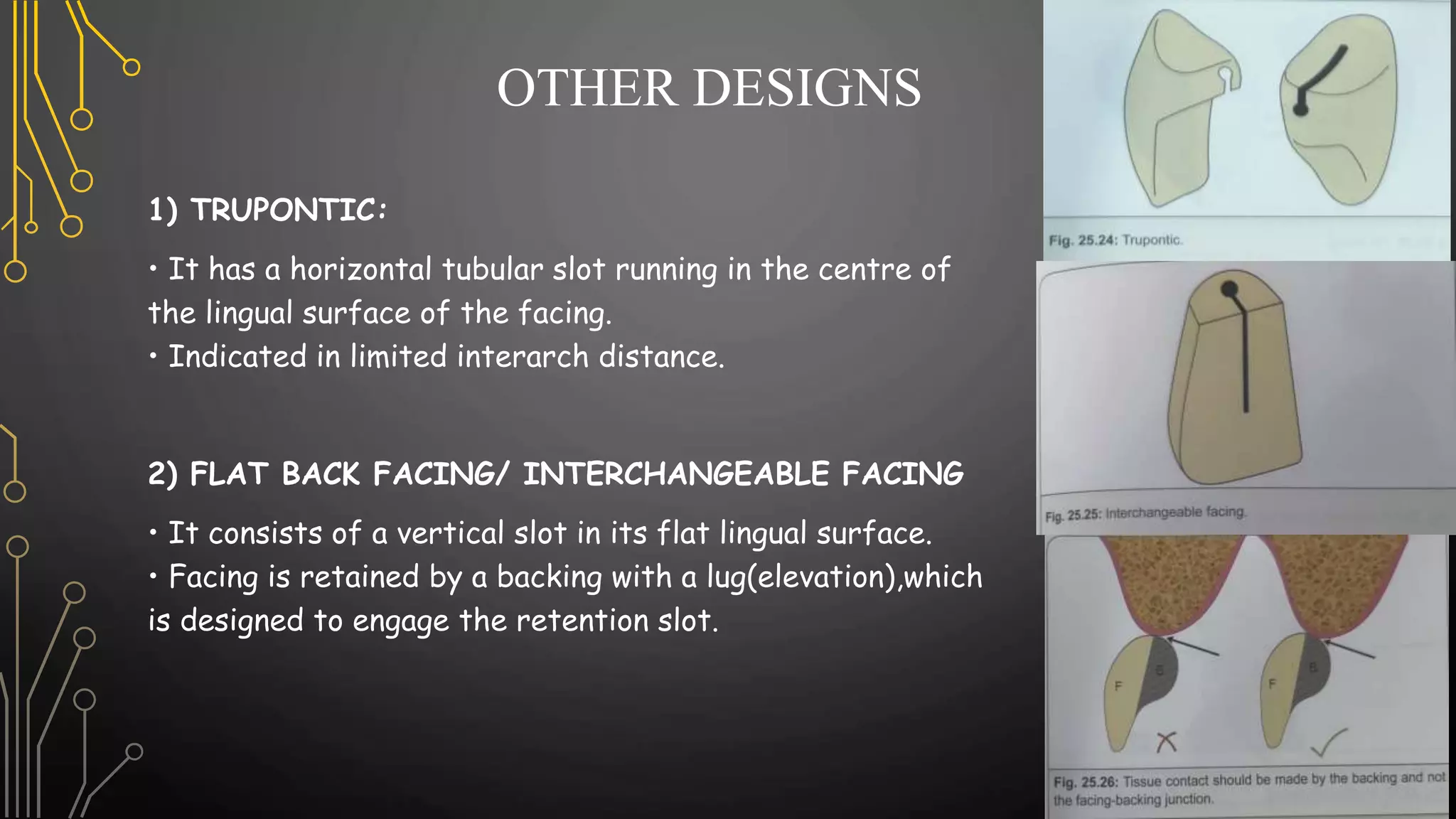 Pontics in Fixed Partial Denture | PPTX