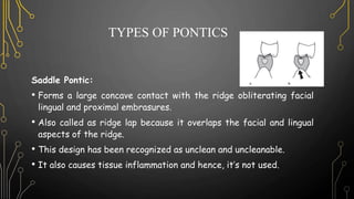 TYPES OF PONTICS
Saddle Pontic:
• Forms a large concave contact with the ridge obliterating facial
lingual and proximal embrasures.
• Also called as ridge lap because it overlaps the facial and lingual
aspects of the ridge.
• This design has been recognized as unclean and uncleanable.
• It also causes tissue inflammation and hence, it’s not used.
 