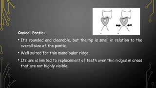 Conical Pontic:
• It’s rounded and cleanable, but the tip is small in relation to the
overall size of the pontic.
• Well suited for thin mandibular ridge.
• Its use is limited to replacement of teeth over thin ridges in areas
that are not highly visible.
 