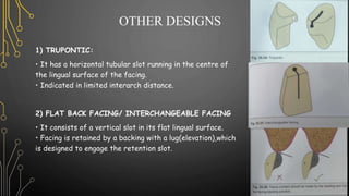 OTHER DESIGNS
1) TRUPONTIC:
• It has a horizontal tubular slot running in the centre of
the lingual surface of the facing.
• Indicated in limited interarch distance.
2) FLAT BACK FACING/ INTERCHANGEABLE FACING
• It consists of a vertical slot in its flat lingual surface.
• Facing is retained by a backing with a lug(elevation),which
is designed to engage the retention slot.
 