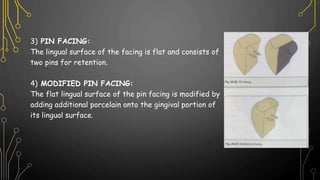 3) PIN FACING:
The lingual surface of the facing is flat and consists of
two pins for retention.
4) MODIFIED PIN FACING:
The flat lingual surface of the pin facing is modified by
adding additional porcelain onto the gingival portion of
its lingual surface.
 