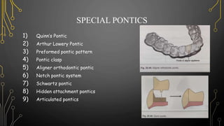 SPECIAL PONTICS
1) Quinn’s Pontic
2) Arthur Lowery Pontic
3) Preformed pontic pattern
4) Pontic clasp
5) Aligner orthodontic pontic
6) Notch pontic system
7) Schwartz pontic
8) Hidden attachment pontics
9) Articulated pontics
 