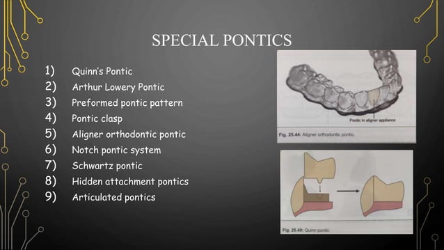 Pontics in Fixed Partial Denture | PPTX