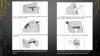 More plaster is added to the facial surface of the
pontic.
If the FPD is to be cast in two pieces,3-0 suture
silk can be used to saw through the connector.
 