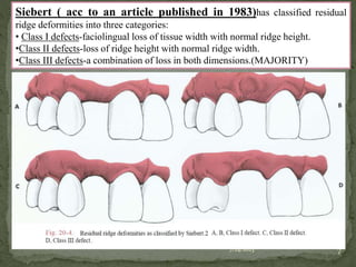 Siberet Ridge Defect PONTICS..pptx