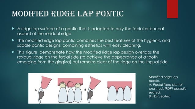 It is of topic PONTICS in fixed partial deture.pptx