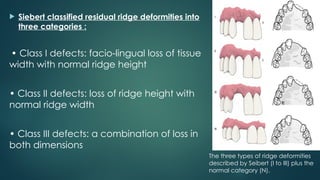 PONTICS as a part of fixed partial denture | PPTX