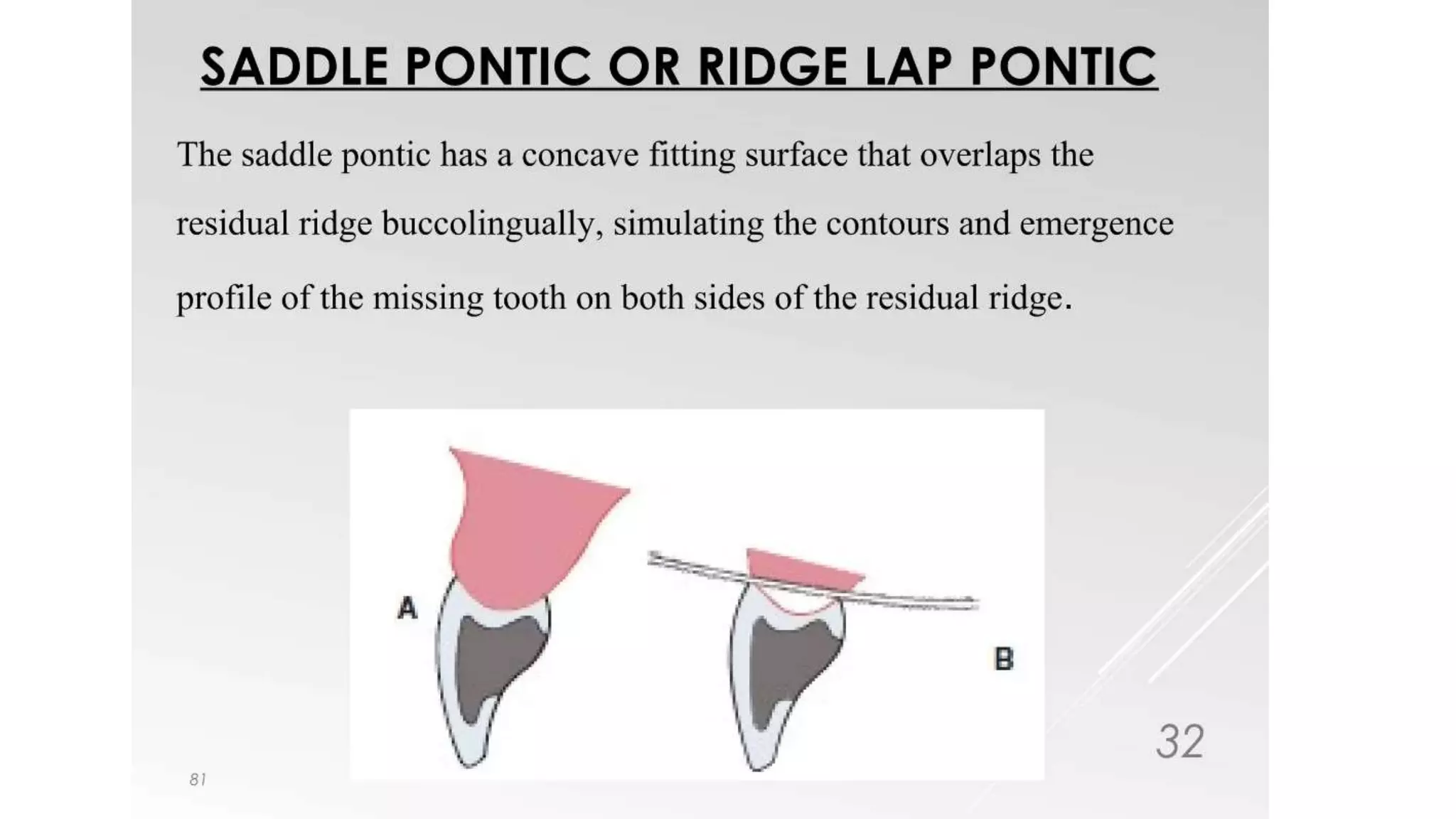 PONTICS IN FIXED PARTIAL DENTURE.pptx