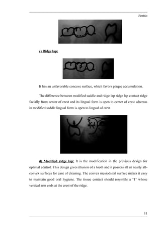 Pontics in fpd | DOC | Oral care | Personal Care