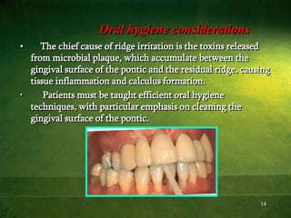 14
Oral hygiene considerations
• The chief cause of ridge irritation is the toxins released
from microbial plaque, which accumulate between the
gingival surface of the pontic and the residual ridge, causing
tissue inflammation and calculus formation.
• Patients must be taught efficient oral hygiene
techniques, with particular emphasis on cleaning the
gingival surface of the pontic.
 