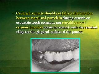 18
• Occlusal contacts should not fall on the junction
between metal and porcelain during centric or
eccentric tooth contacts, nor should a metal
ceramic junction occur in contact with the residual
ridge on the gingival surface of the pontic.
 