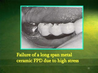 22
Failure of a long span metal
ceramic FPD due to high stress
 