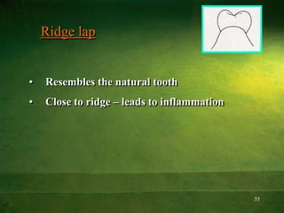 35
Ridge lap
• Resembles the natural tooth
• Close to ridge – leads to inflammation
 