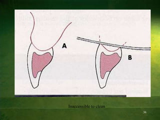 36
Inaccessible to clean
 