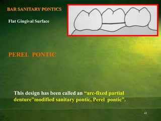 41
BAR SANITARY PONTICS
Flat Gingival Surface
This design has been called an “arc-fixed partial
denture”modified sanitary pontic, Perel pontic”.
PEREL PONTIC
 