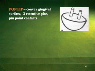 47
PONTIP – convex gingival
surface, 2 retentive pins,
pin point contacts
 