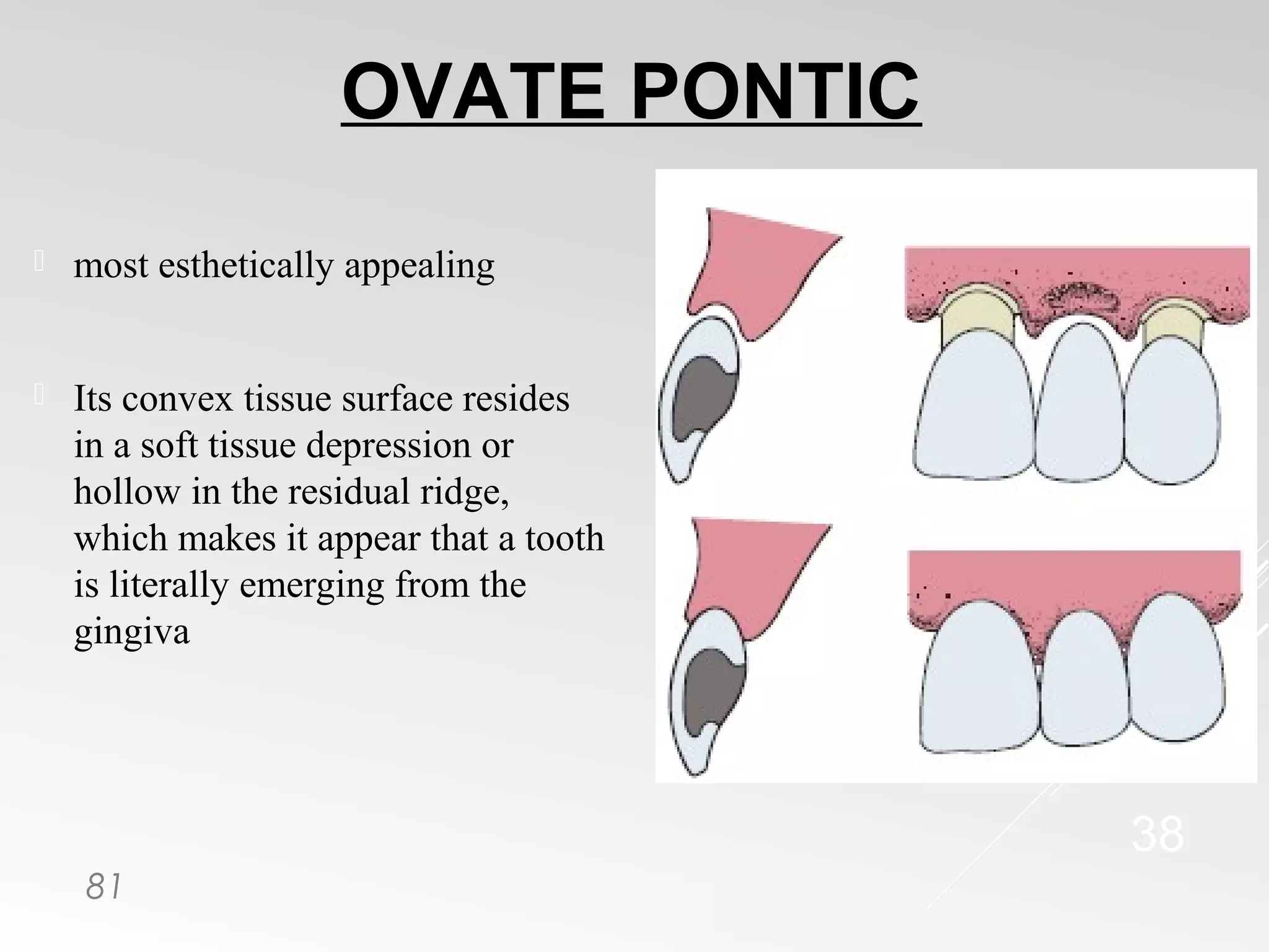 Pontics in Fixed Partial Dentures | PPT