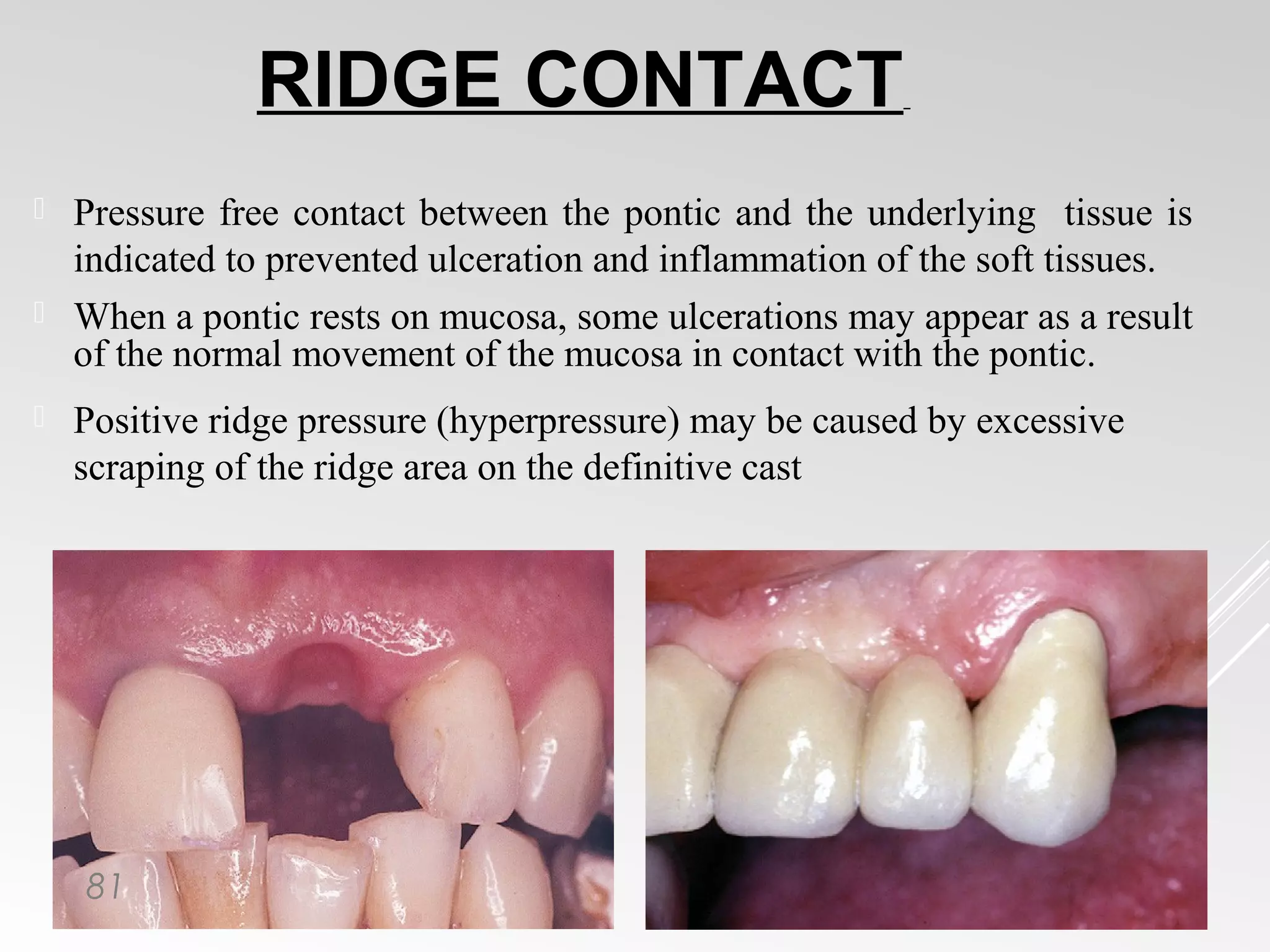 Pontics in Fixed Partial Dentures | PPT
