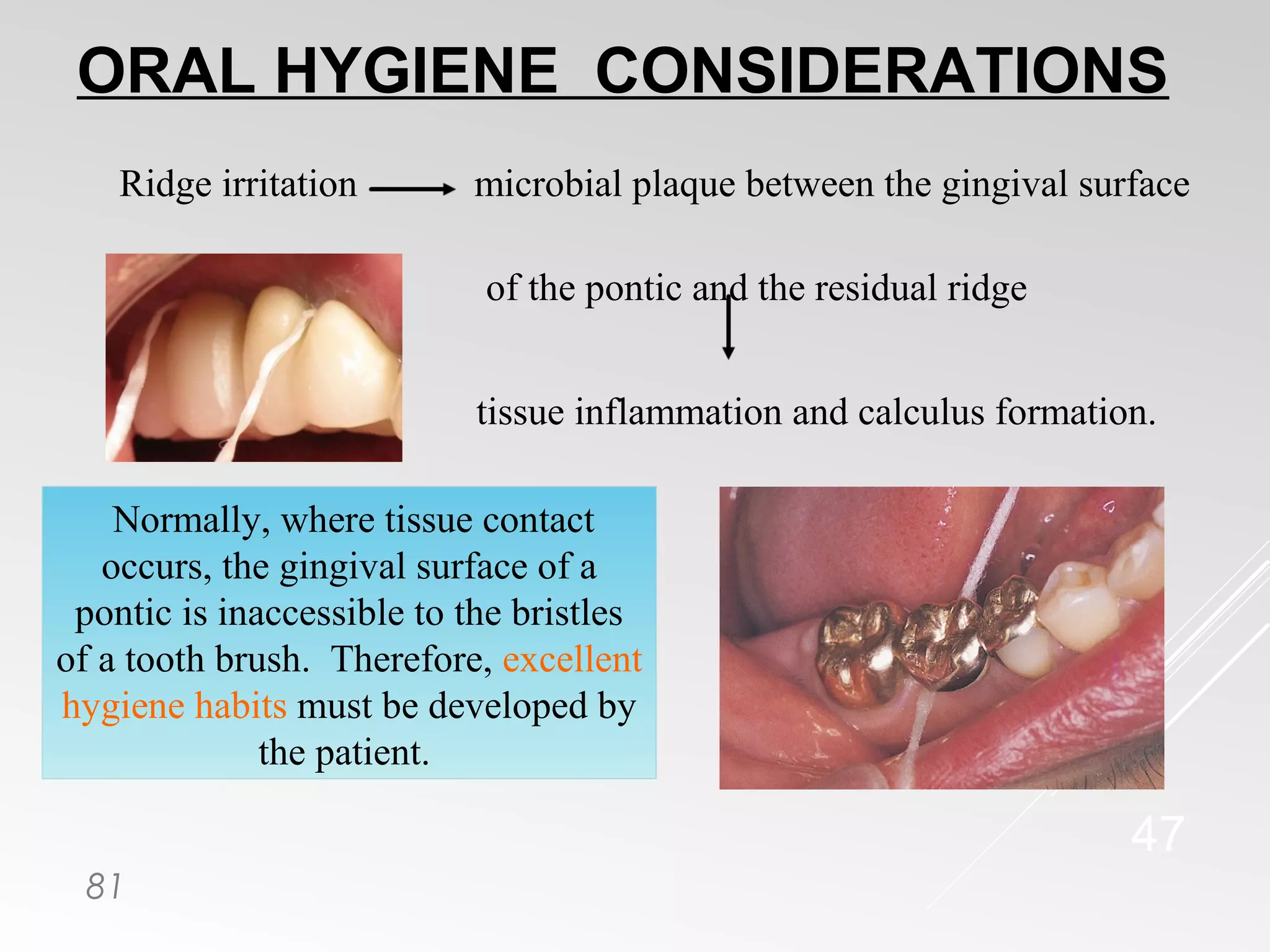 Calculus Ridge Pontics in Fixed Partial Dentures | PPT