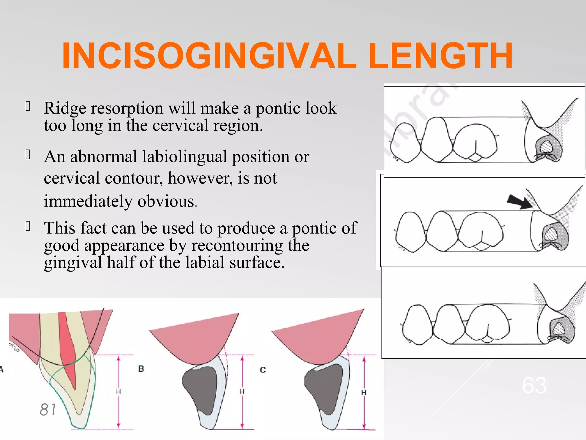 Pontics in Fixed Partial Dentures | PPT