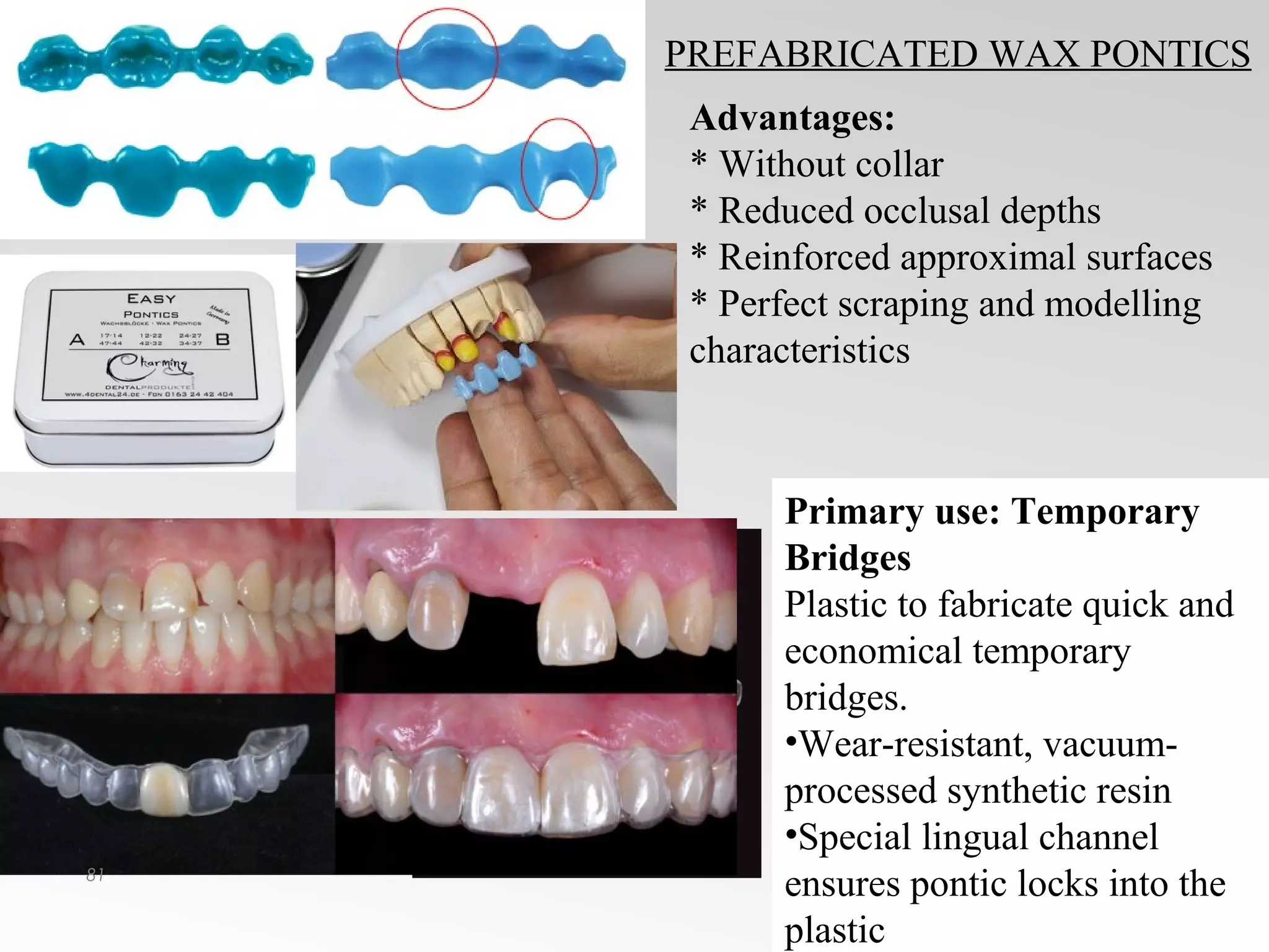 Pontics in Fixed Partial Dentures | PPT