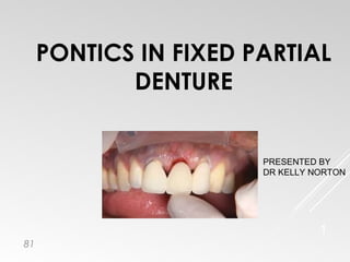 PONTICS IN FIXED PARTIAL
DENTURE
1
PRESENTED BY
DR KELLY NORTON
81
 