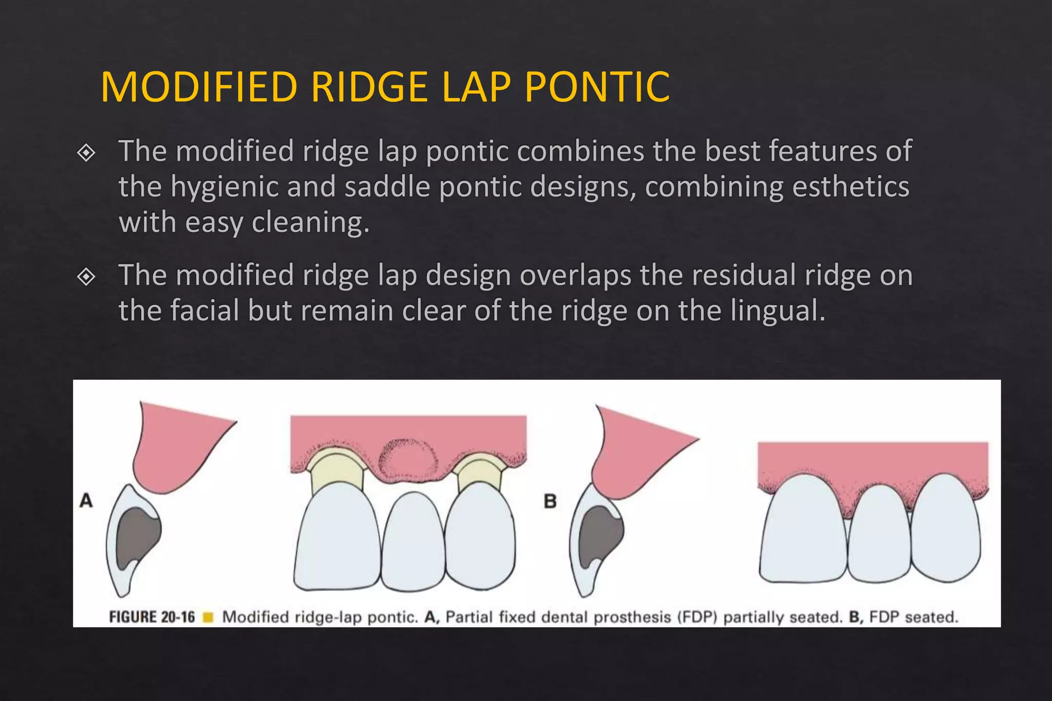 Pontics seminar | PPTX