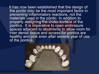 It has now been established that the design of
the pontic may be the most important factor in
preventing inflammatory reactions, not the
materials used in the pontic. In addition to
properly designing the under surface of the
pontics. It is imperative to open embrasure
spaces adjacent to abutments to allow room for
inter dental tissue and access for pontics are
healthy and pink even after several year of use
of the pontics.
 