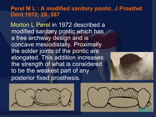 Morton L Perel in 1972 described a
modified sanitary pontic which has
a free archway design and is
concave mesiodistally. Proximally
the solder joints of the pontic are
elongated. This addition increases
the strength of what is considered
to be the weakest part of any
posterior fixed prosthesis.
Perel M L : A modified sanitary pontic. J Prosthet
Dent 1972; 28: 587
BACK
 