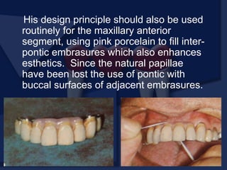 His design principle should also be used
routinely for the maxillary anterior
segment, using pink porcelain to fill inter-
pontic embrasures which also enhances
esthetics. Since the natural papillae
have been lost the use of pontic with
buccal surfaces of adjacent embrasures.
 