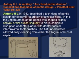 Antony H L in 1983 described a technique of pontic
design for extreme resorption of alveolar ridge. In this
the undersurface of the pontic was shaped slightly
convex or flat bucco-lingually to aid in complete
disruption of dental plaque with dental floss or
interproximal toothbrushes. The flat undersurface
allowed easy cleaning from either the lingual or buccal
aspect.
Antony H L: A sanitary “ Arc- fixed partial denture” :
Concept and technique of pontic design. J Prosthet Dent
1983; 50: 338
 