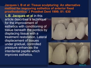 L.B. Jacques et al in this
article describes a technique
for the improvement of
esthetics with conditioning of
tissue beneath the pontics by
displacing tissue with a
treatment restoration. Lateral
displacement of tissues
under gradual, controlled
pressure enhances the
interdental papilla which
improves esthetics.
Jacques L B et al: Tissue sculpturing: An alternative
method for improving esthetics of anterior fixed
prosthodontics. J Prosthet Dent 1999; 81: 630
BACK
 