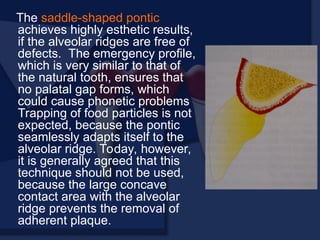 The saddle-shaped pontic
achieves highly esthetic results,
if the alveolar ridges are free of
defects. The emergency profile,
which is very similar to that of
the natural tooth, ensures that
no palatal gap forms, which
could cause phonetic problems
Trapping of food particles is not
expected, because the pontic
seamlessly adapts itself to the
alveolar ridge. Today, however,
it is generally agreed that this
technique should not be used,
because the large concave
contact area with the alveolar
ridge prevents the removal of
adherent plaque.
 