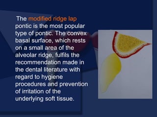 The modified ridge lap
pontic is the most popular
type of pontic. The convex
basal surface, which rests
on a small area of the
alveolar ridge, fulfils the
recommendation made in
the dental literature with
regard to hygiene
procedures and prevention
of irritation of the
underlying soft tissue.
 