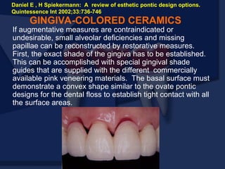 If augmentative measures are contraindicated or
undesirable, small alveolar deficiencies and missing
papillae can be reconstructed by restorative measures.
First, the exact shade of the gingiva has to be established.
This can be accomplished with special gingival shade
guides that are supplied with the different commercially
available pink veneering materials. The basal surface must
demonstrate a convex shape similar to the ovate pontic
designs for the dental floss to establish tight contact with all
the surface areas.
GINGIVA-COLORED CERAMICS
Daniel E , H Spiekermann: A review of esthetic pontic design options.
Quintessence Int 2002;33:736-746
 