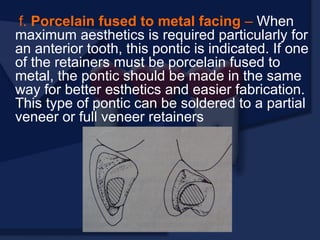 f. Porcelain fused to metal facing – When
maximum aesthetics is required particularly for
an anterior tooth, this pontic is indicated. If one
of the retainers must be porcelain fused to
metal, the pontic should be made in the same
way for better esthetics and easier fabrication.
This type of pontic can be soldered to a partial
veneer or full veneer retainers
 